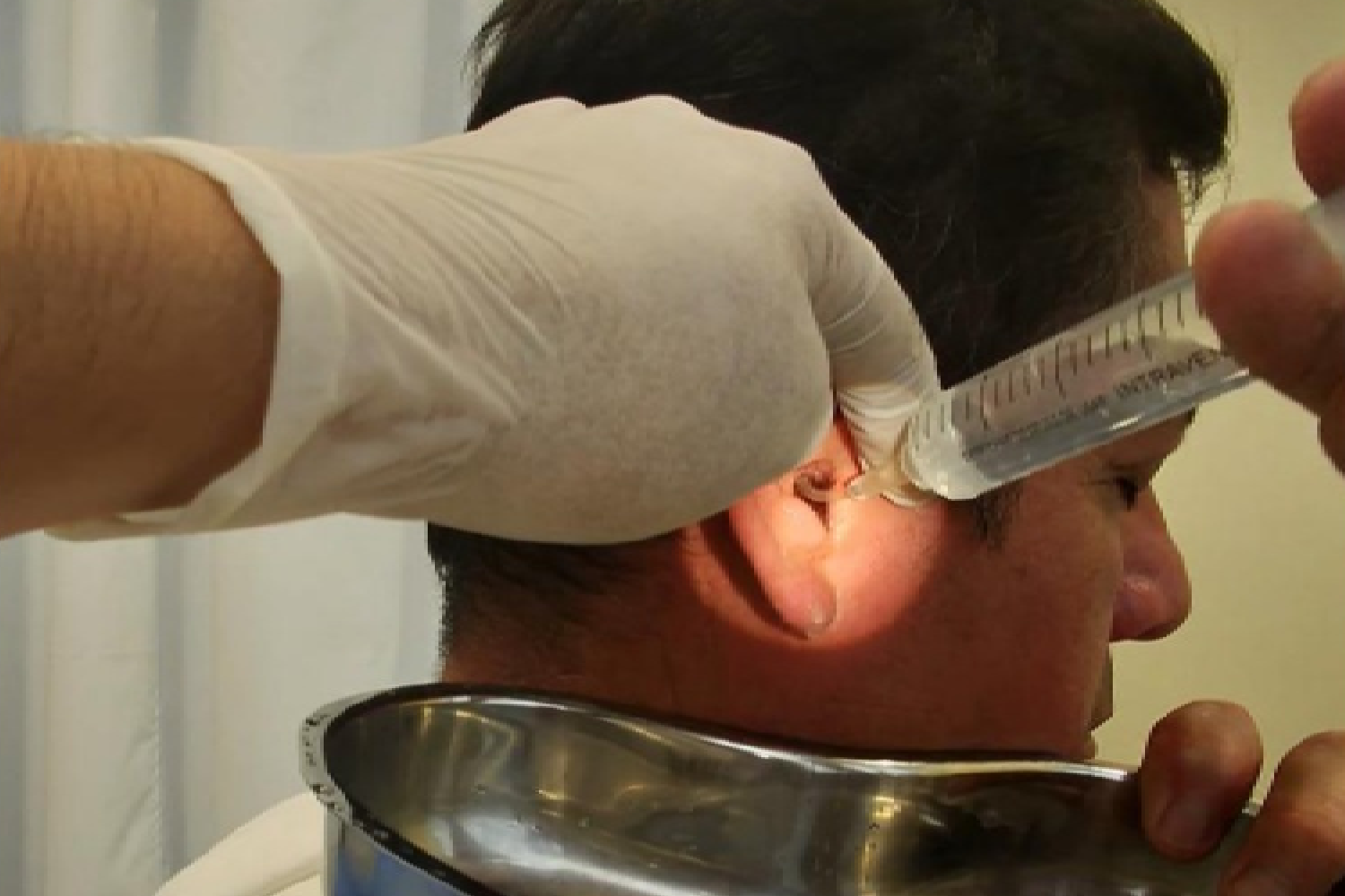 Lavado de oídos (tradicional)