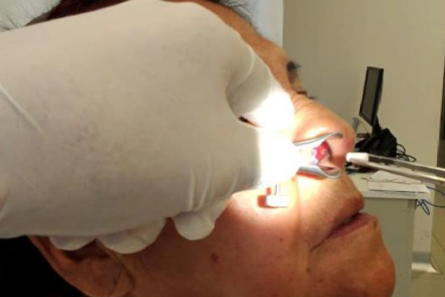 Cauterización de fosas nasales